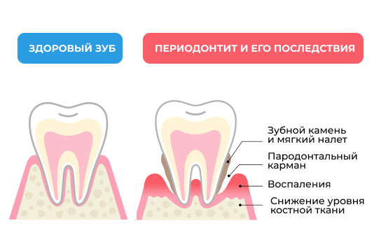 Показания к лечению периодонтита