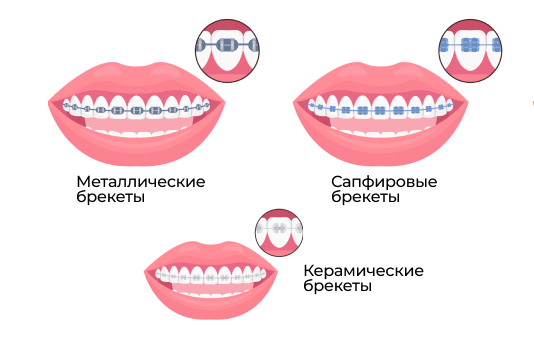 Типы брекетов