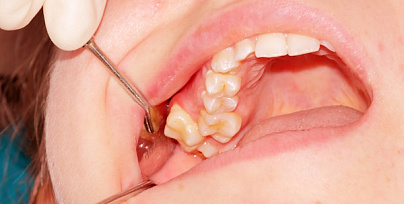 Удаление дистопированного зуба фото