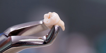 Сложное удаление зуба фото